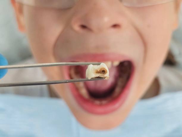 Best Emergency Wisdom Teeth Removal in New Hempstead, NY